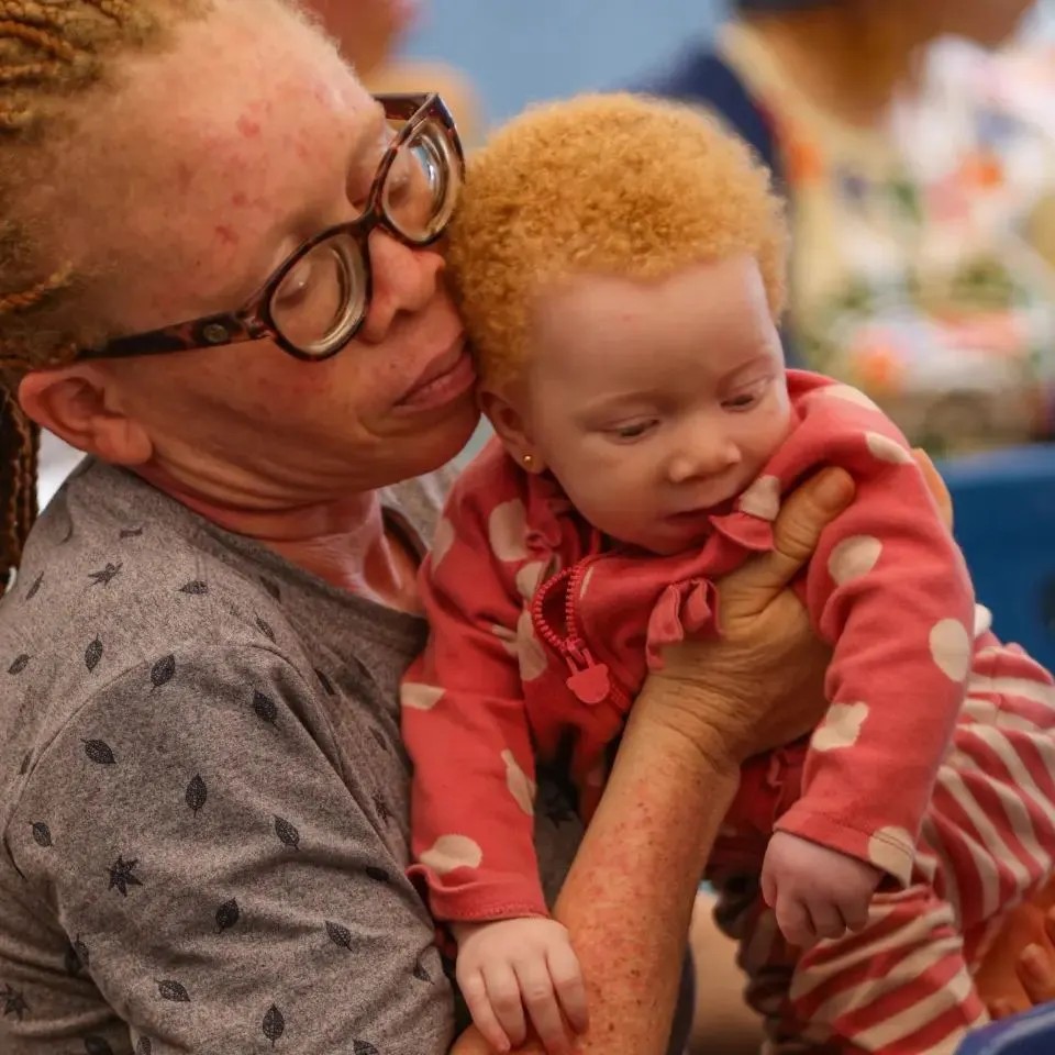 Read more about the article “Albino not insult. Persons with albinism must be respected” — Group Advocates