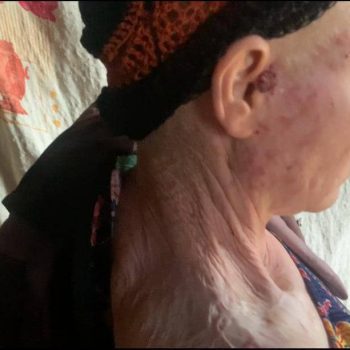 Read more about the article Persons with albinism dying of skin cancer due to inadequate healthcare access, funds