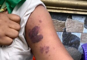 Bruises on Jumoke Balogun from her husband’s violence. Photo source: HumAngle Media